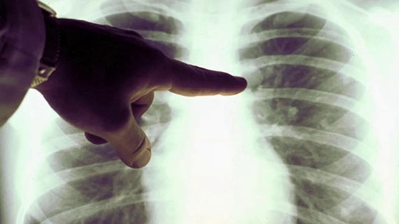 Lung Screening at Chester County Hospital Detects Cancer in its Early Stages.